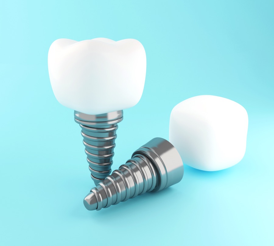 implantes dentales Implantes dentales Torremolinos - clínica dental Neptuno