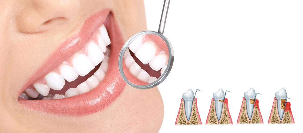 Periodoncia Torremolinos Periodoncia en Torremolinos - Clínica dental
