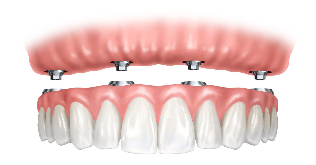 prótesis dentales Especialistas prótesis dentales Torremolinos - Clínica dental Neptuno